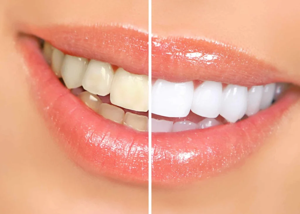 Our Hour Teeth Whitening