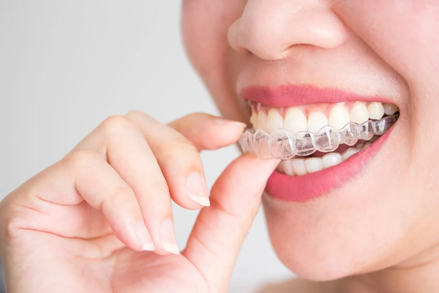 Clear Aligners Meridian