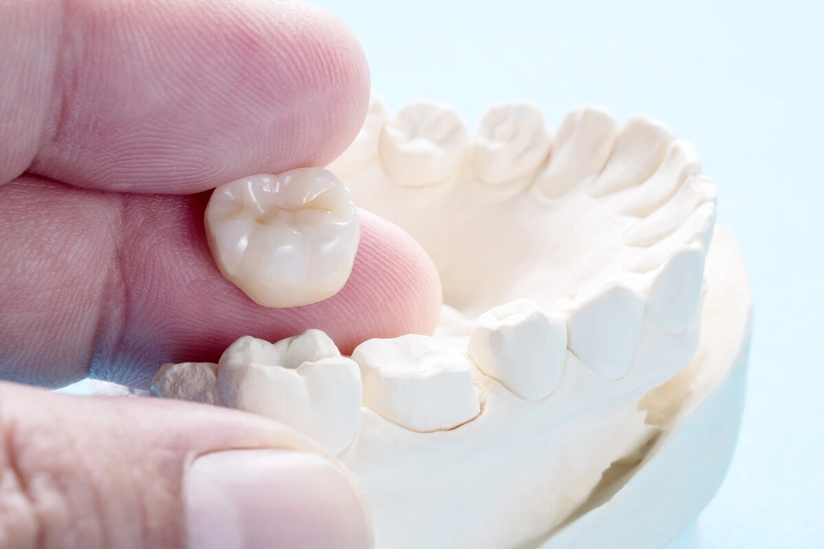 Dental Crowns for Molars