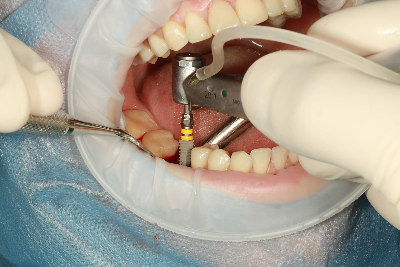 Dental Implants Meridian