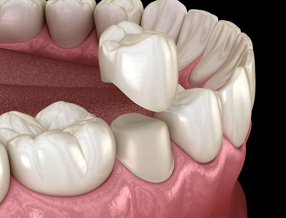 Porcelain Dental Crowns Meridian