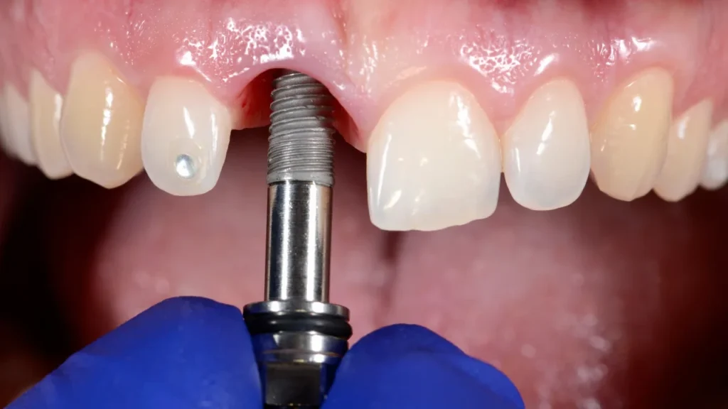 Single Tooth Implant Cost