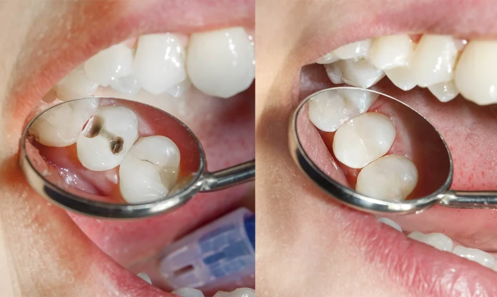 fix broken teeth